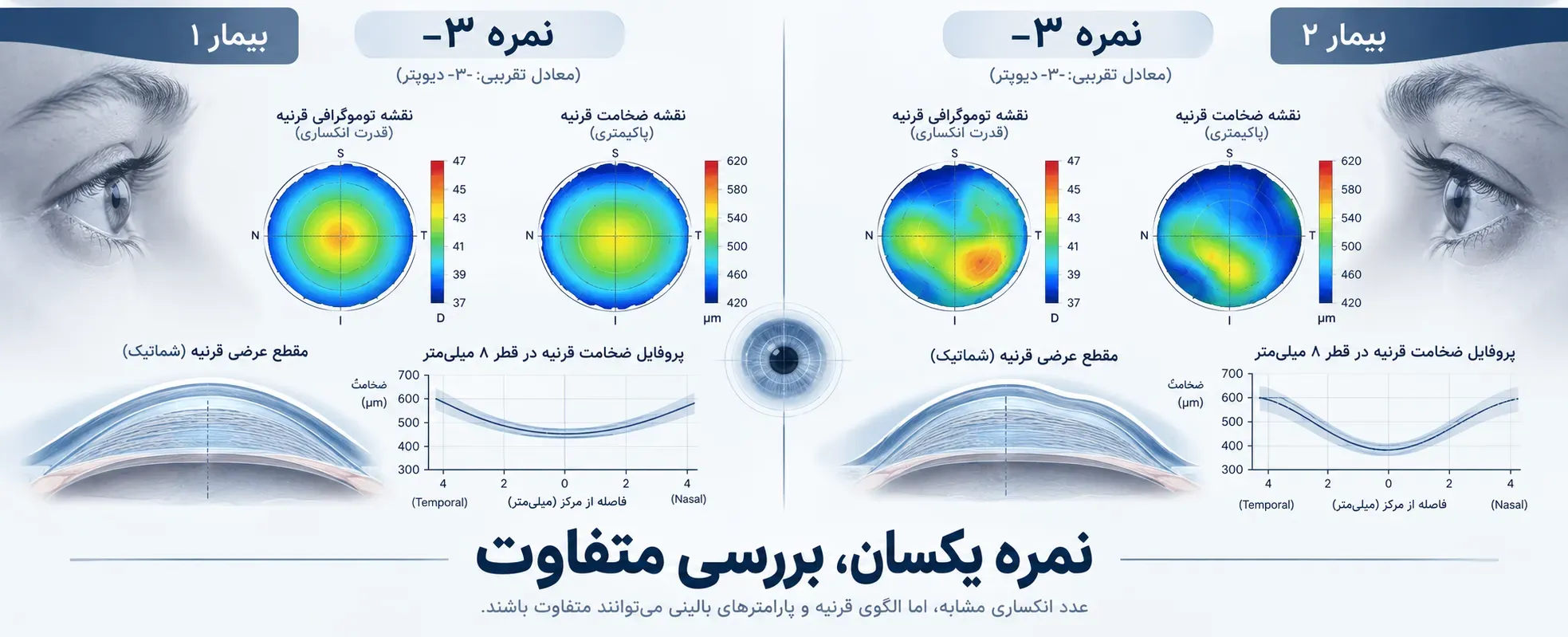 دو فرد با نمره چشم یکسان و شرایط قرنیه متفاوت