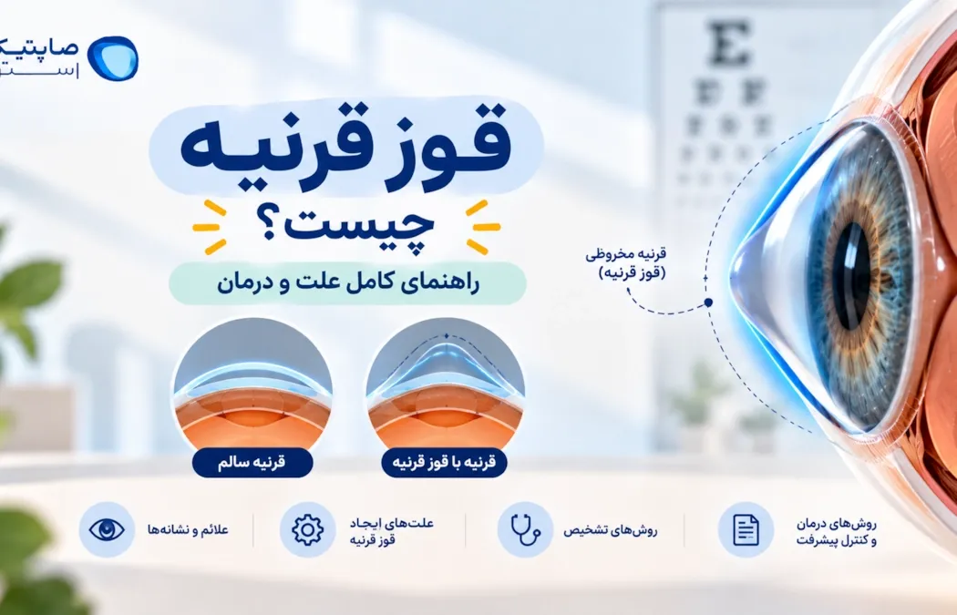 قوز قرنیه چیست؟ راهنمای کامل علت و درمان