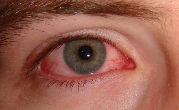 گلوکوم یا آب سیاه (Glaucoma)