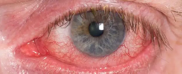 انسداد ورید شبکیه (Retinal vein occlusion)