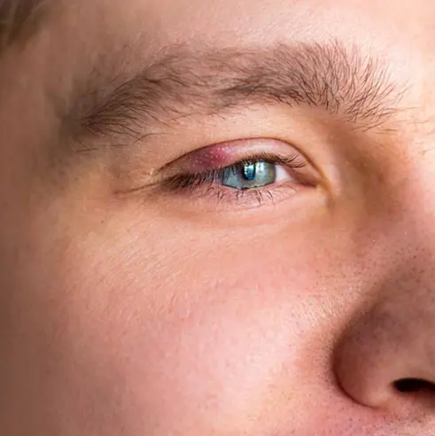 گل مژه چیست؟ + علائم و درمان سریع گل مژه 3 علت ایجاد گل مژه