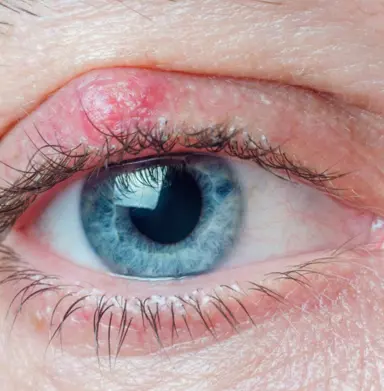 گل مژه چیست؟ + علائم و درمان سریع گل مژه 4 تشخیص گل مژه