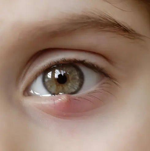 گل مژه چیست؟ + علائم و درمان سریع گل مژه 2 گل مژه چشم